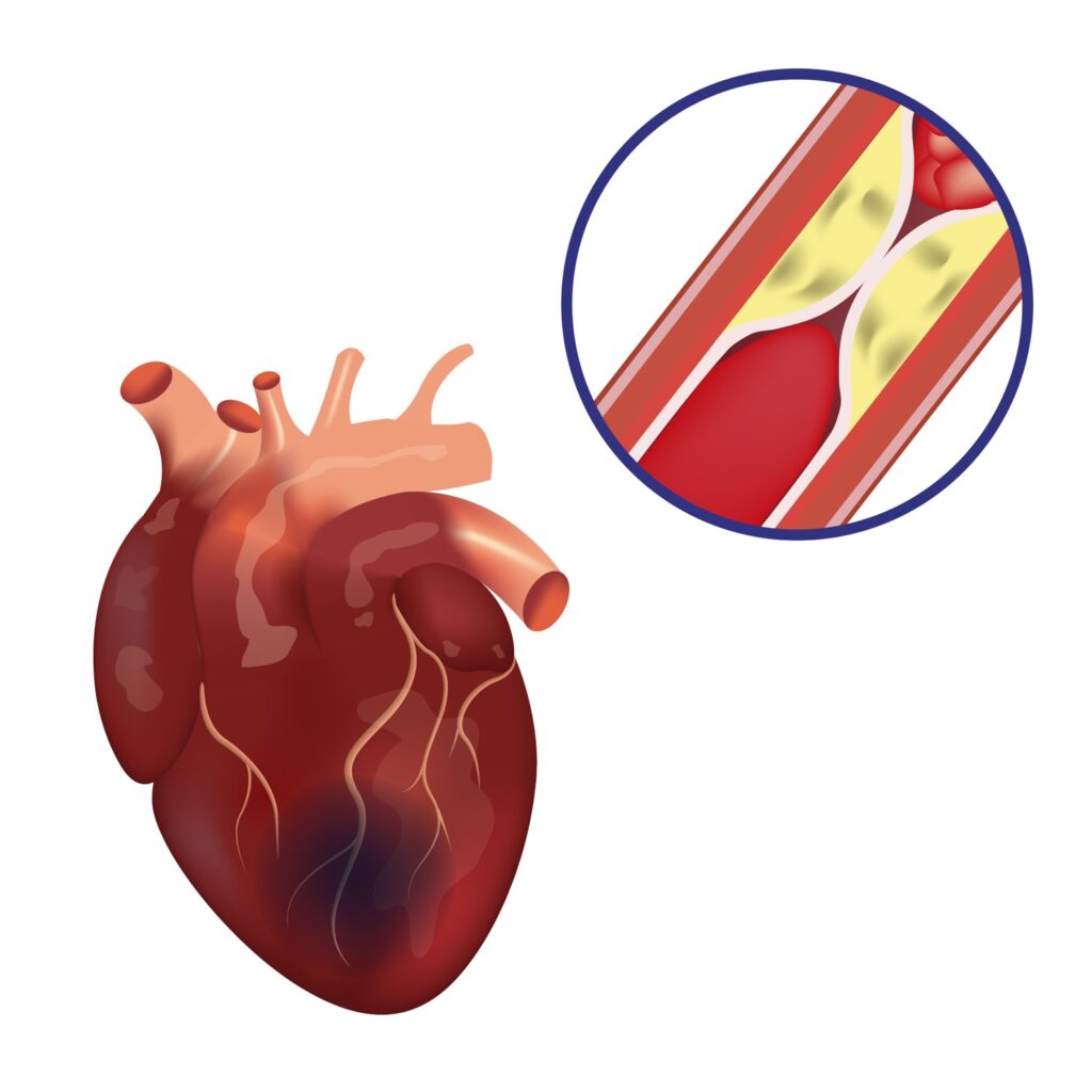 Know More About Coronary Artery Disease